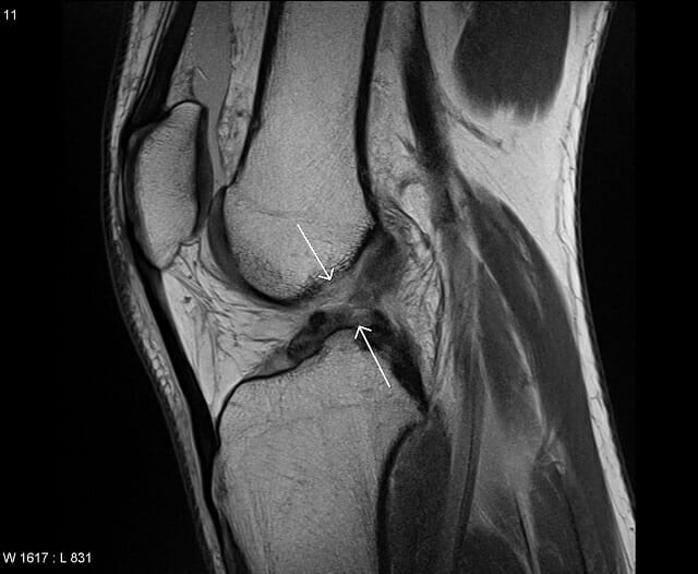 Common Ski Injuries: The Knees And Back How To Protect Them 1 Partial Acl Tear Ski Injury